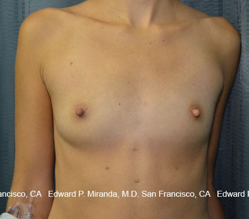 Breast Augmentation Before & After Image