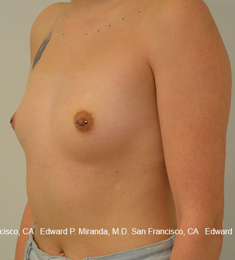 Breast Augmentation Before & After Image