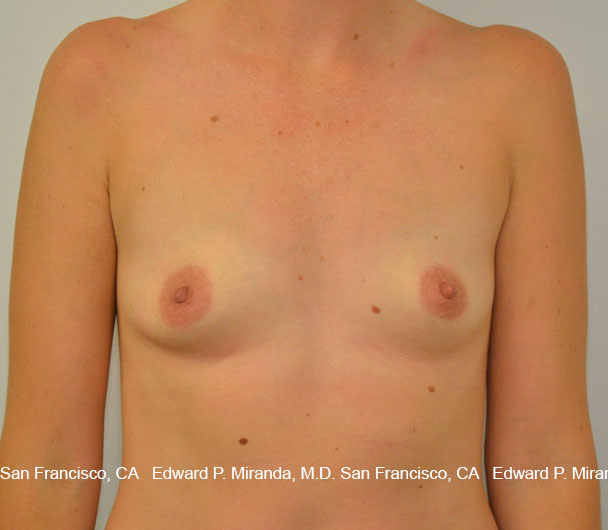 Breast Augmentation Before & After Image