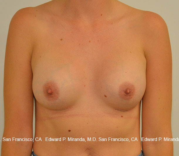 Breast Augmentation Before & After Image