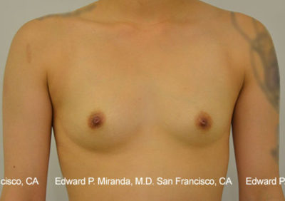 Breast Augmentation Before & After Image