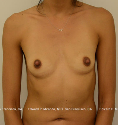 Breast Augmentation Before & After Image