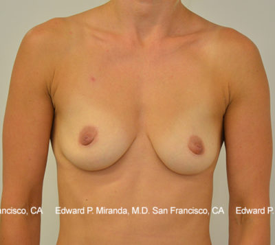 Breast Augmentation Before & After Image