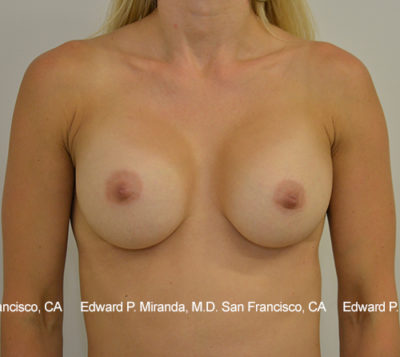 Breast Augmentation Before & After Image