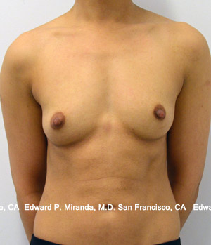 Breast Augmentation Before & After Image