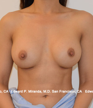 Breast Augmentation Before & After Image