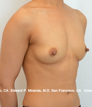 Breast Augmentation Before & After Image