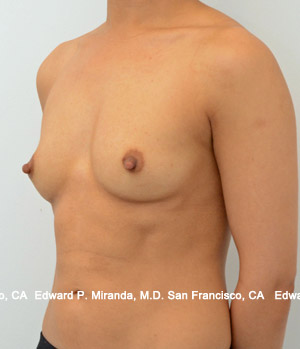 Breast Augmentation Before & After Image