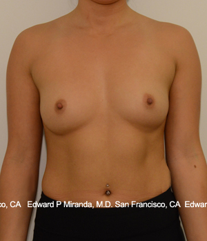 Breast Augmentation Before & After Image