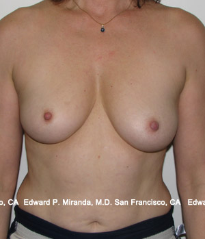 Breast Augmentation Before & After Image