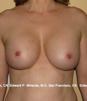 Breast Augmentation Before & After Image