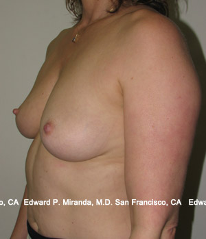 Breast Augmentation Before & After Image