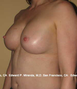 Breast Augmentation Before & After Image