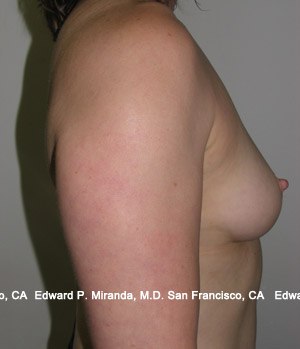 Breast Augmentation Before & After Image