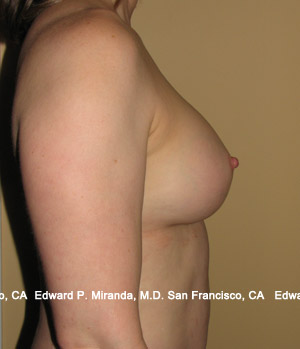 Breast Augmentation Before & After Image