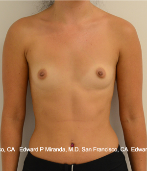 Breast Augmentation Before & After Image