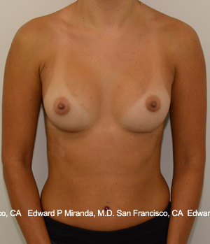 Breast Augmentation Before & After Image