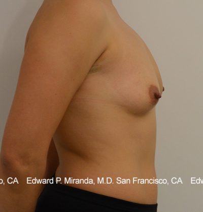 Breast Augmentation Before & After Image