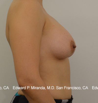 Breast Augmentation Before & After Image