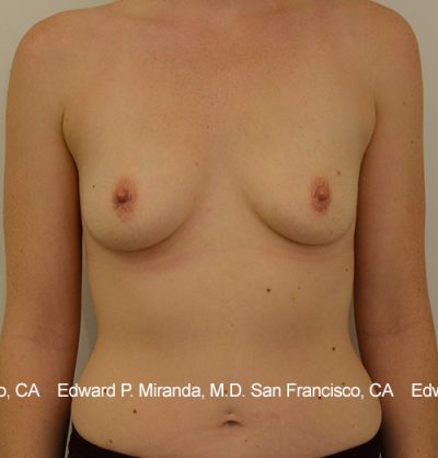 Breast Augmentation Before & After Image