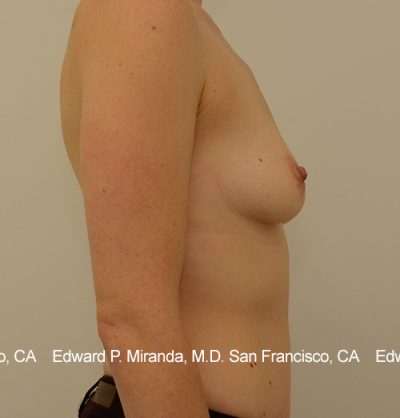 Breast Augmentation Before & After Image