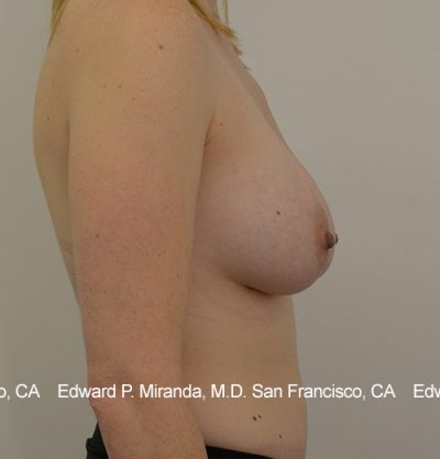 Breast Augmentation Before & After Image