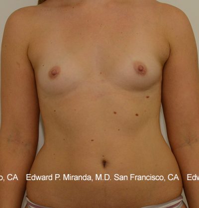 Breast Augmentation Before & After Image