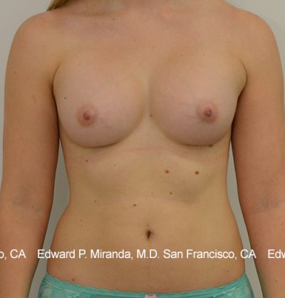 Breast Augmentation Before & After Image