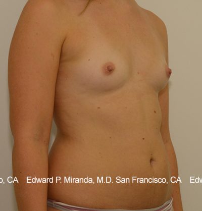 Breast Augmentation Before & After Image