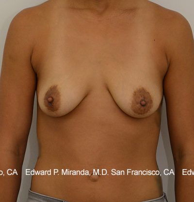 Breast Augmentation Before & After Image