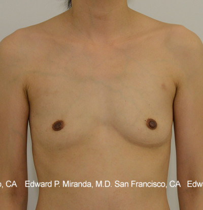 Breast Augmentation Before & After Image