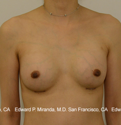 Breast Augmentation Before & After Image