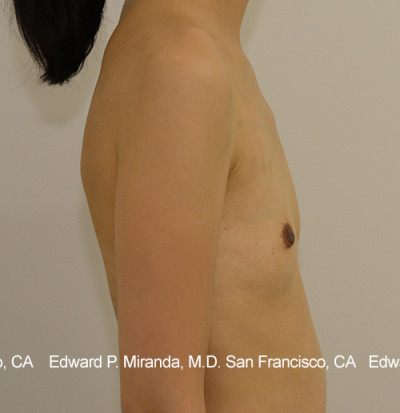 Breast Augmentation Before & After Image