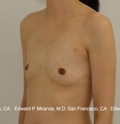 Breast Augmentation Before & After Image