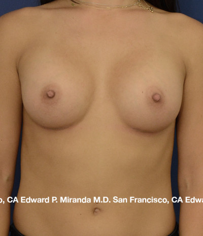 Breast Augmentation Before & After Image