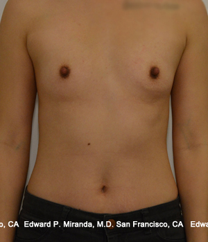 Breast Augmentation Before & After Image