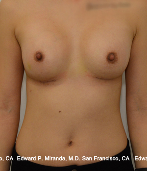 Breast Augmentation Before & After Image