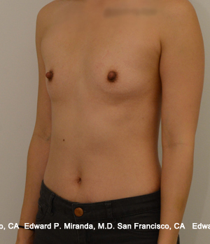 Breast Augmentation Before & After Image