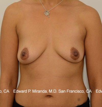 Breast Augmentation Before & After Image