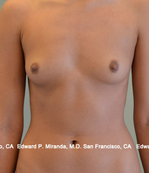 Breast Augmentation Before & After Image