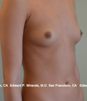 Breast Augmentation Before & After Image