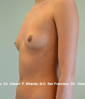 Breast Augmentation Before & After Image