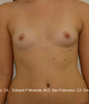 Breast Augmentation Before & After Image