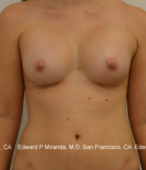 Breast Augmentation Before & After Image