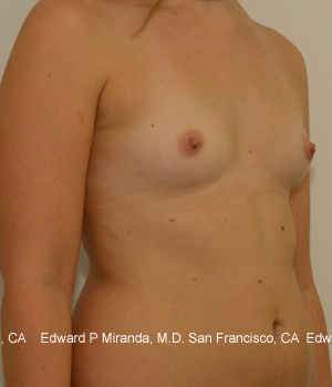 Breast Augmentation Before & After Image