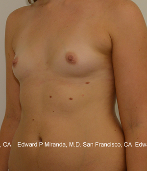 Breast Augmentation Before & After Image