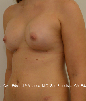 Breast Augmentation Before & After Image