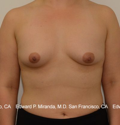 Breast Augmentation Before & After Image