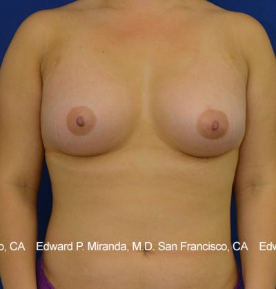 Breast Augmentation Before & After Image