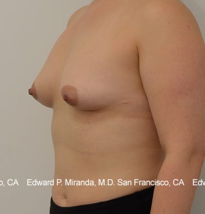 Breast Augmentation Before & After Image